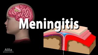 Meningitis Pathology Causes Symptoms Diagnosis and Treatment Animation [upl. by Yasui]