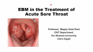 Treatment of Acute Sore Throat [upl. by Enimasaj]