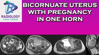 Bicornuate uterus with pregnancy in one horn [upl. by Navad719]