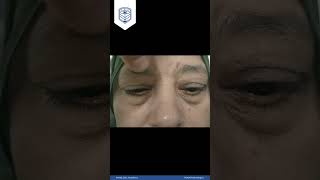 Educational Video 33 Left Limited Abduction Abducent palsy [upl. by Caz]