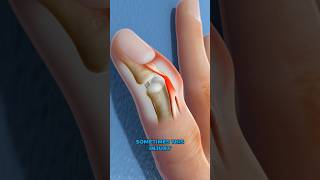 What is mallet finger 3D Animation [upl. by Refotsirc]