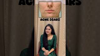 Acne scars treatment For bookings 📞859785850 acne acnescars [upl. by Codd466]