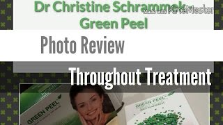 Dr Christine Schrammek  Green Peel Classic  Photo Review Throughout Treatment [upl. by Gwenni]