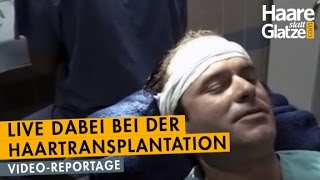 Manuel Horeth DER MENTALIST LiveReportage seiner Haartransplantation [upl. by Carena]