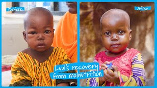 Luul’s recovery from severe malnutrition in Somalia  UNICEF [upl. by Calan339]