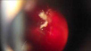 Laser Floater Removal  Titrating Coaxial lllumination by Dr Paul Singh [upl. by Winfred80]