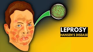 Leprosy Hansens disease Everything You Need to Know [upl. by Atteloj551]