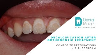 Decalcification after orthodontic treatment Composite restorations in a rubberdam 🦷💡 [upl. by Kerby]