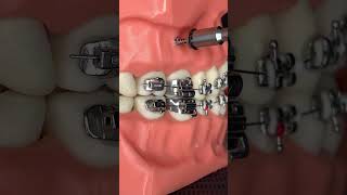 🔥Instalación de tornillos 🔩 en los BRACKETS 😬 SIN DOLOR 😫🔥 [upl. by Delanie]