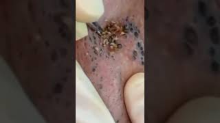 Elderly Blackhead Removal blackheads acne elderly pimplepopping whiteheads satisfying asmr [upl. by Tarfe151]