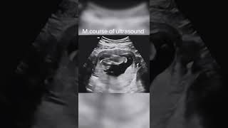 12 weeks pregnancy trending baby ultrasound newborn subscribe shorts [upl. by Nawuj]