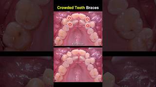 Complex braces for crowded teeth braces orthodontist dentist [upl. by Solrak]