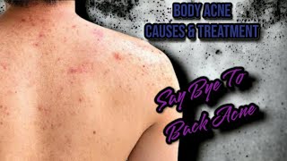 How To Remove Body Acne Fast What Causes Body Acne Back Acne Treatment [upl. by Adnuhser]