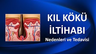 KIL KÖKÜ İLTİHABI Nedenleri ve Tedavisi [upl. by Iy480]