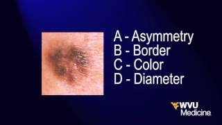 Moles and Skin Cancer  WVU Medicine Health Report [upl. by Htiduy]