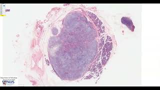 Salivary gland Pleomorphic adenoma Microscopy  Talking slide [upl. by Neuburger]