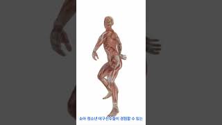 팔꿈치 관절  청소년 박리성 골연골염의 이해 Elbow Joints Understanding Osteochondritis Dissecans in Adolescents [upl. by Gilead527]