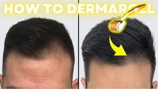 How to Derma Roll for Quickest Hair Results StepbyStep Guide [upl. by Lacym]