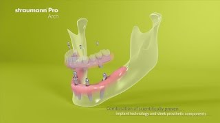 Straumann® Pro Arch US Version [upl. by Bridie]