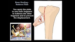 Bone Healing Buttress Plate  Everything You Need To Know  Dr Nabil Ebraheim [upl. by Palmira]