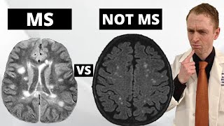 MS MRI Lesions VS quotBenignquot White Matter Lesions Explained by Neurologist [upl. by Lipinski497]