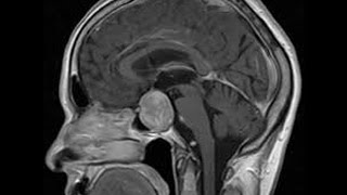 ADENOMA PITUITARIO  TUMOR O PROTUBERANCIA EN LA PITUITARIA [upl. by Dulla]