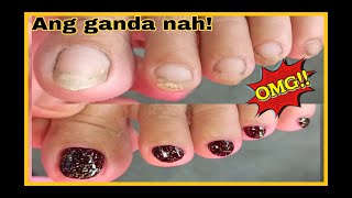 PEDICURE 85 INGROWNDRY SKIN REMOVAL ozamiz manicurista [upl. by Zondra]