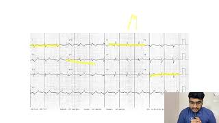 MASTERING ECGLESSON15 RIGHT BUNDLE BRANCH BLOCK RBBB [upl. by Anneliese]