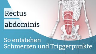 Rectus abdominis Schmerzen Triggerpunkte und deren Aktivierung [upl. by Yemrots]