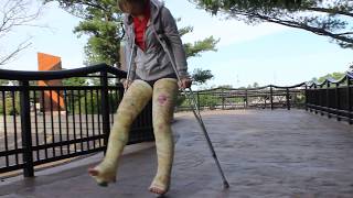 Emily with 2 broken legs [upl. by Nance]