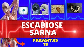 ESCABIOSE  SARNA HUMANA SARCOPTES SCABIEI HOMINIS  PARASITOLOGIA  INFECTOLOGIA [upl. by Ennoitna]