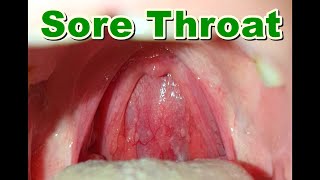 Normal vs Sore Throat  Pharyngitis [upl. by Donegan]