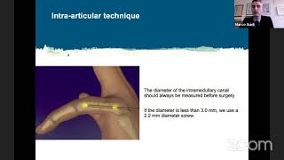 Intramedullary Compression Fixation of Metacarpal and Phalangeal Fractures [upl. by Hulton491]