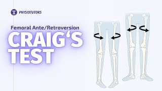 Craigs Test  Femoral Anteversion [upl. by Tager659]