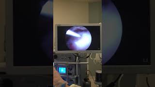 Dr Mora Pimple Popper Of the Shoulder Calcific Tendinitis Treatment [upl. by Ahseele]