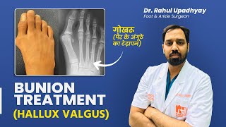 Bunion Treatment in Hindi  गोखरू Hallux Valgus का इलाज कैसे करें  Dr Rahul Upadhyay [upl. by Nahseez]