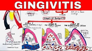 Gingivitis  Stages of Gingival Inflammation [upl. by Noorah]