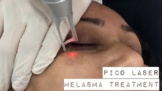 Melasma treatment with PICO Laser [upl. by Boykins]