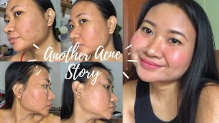 I used Hello Glow Blemish Miracle Set  Another Acne Story [upl. by Sussman]