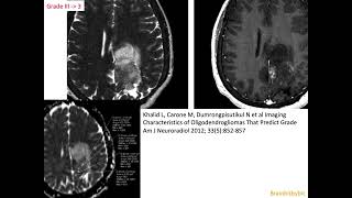 63 Oligodendroglioma 1p19q codeleted IDHmutant corticalsubcortical mass oligoastrocytoma [upl. by Yeldnarb810]