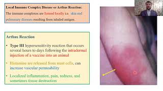 Type III – Hypersensitivity Reactions Part 3 [upl. by Acirat765]