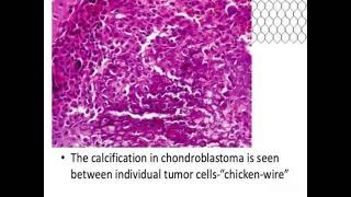 Chondroblastoma shows Chiken wire calcification [upl. by Subir]