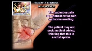 Scaphoid Fractures  Everything You Need To Know  Dr Nabil Ebraheim [upl. by Enylrac289]