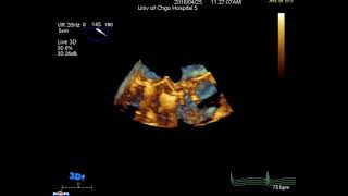 Prosthetic Mitral Valve Obstruction  3D Echo [upl. by Hortensia]