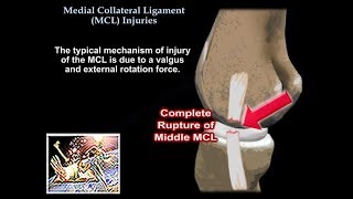 Medial Collateral Ligament Injuries  Everything You Need To Know  Dr Nabil Ebraheim [upl. by Adhamh]