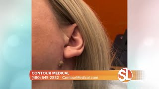 Contour Medical offers scarless mole and skin tag removal [upl. by Demetri]