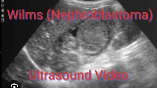 NEPHROBLASTOMA Wilms Tumor ultrasound appearence on video demonstration [upl. by Lucic]