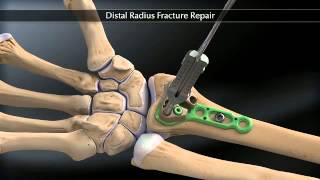 Arthrex Distal Radius Fracture Fixation [upl. by Ivette]