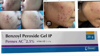 Pernex AC 25 Gel Benzoyl Peroxide Gel [upl. by Llirred]