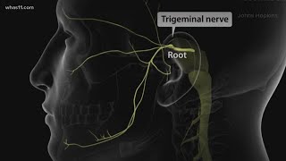 Trigeminal Neuralgia local doctors may have found the cure [upl. by Kannry]